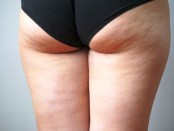 cellulite behandeln